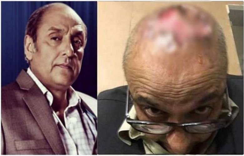 Pakistani Actor Syed Sajid Hasan Hair Transplant Goes Wrong
